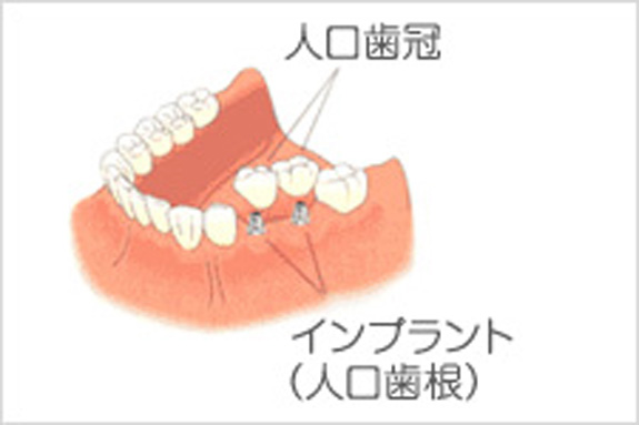 ブリッジ　→　インプラント