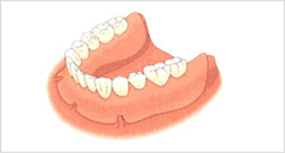 バネを用いた義歯→インプラント3