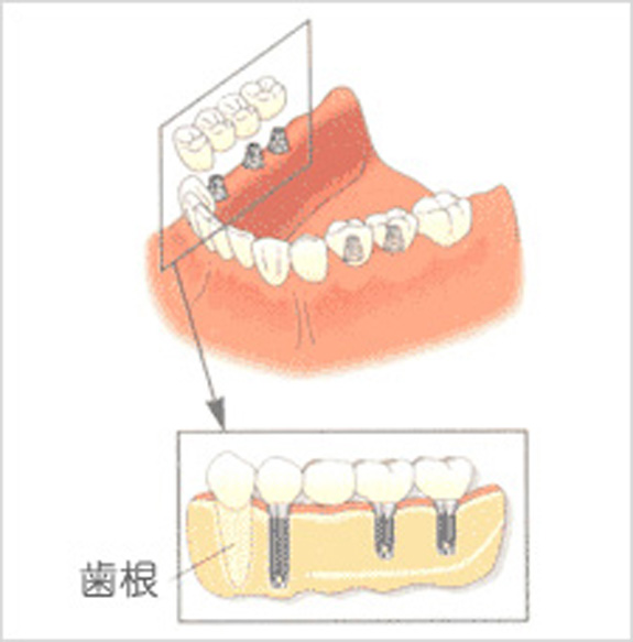 バネを用いた義歯→インプラント2