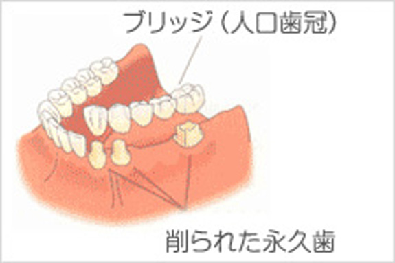 ブリッジ　→　インプラント