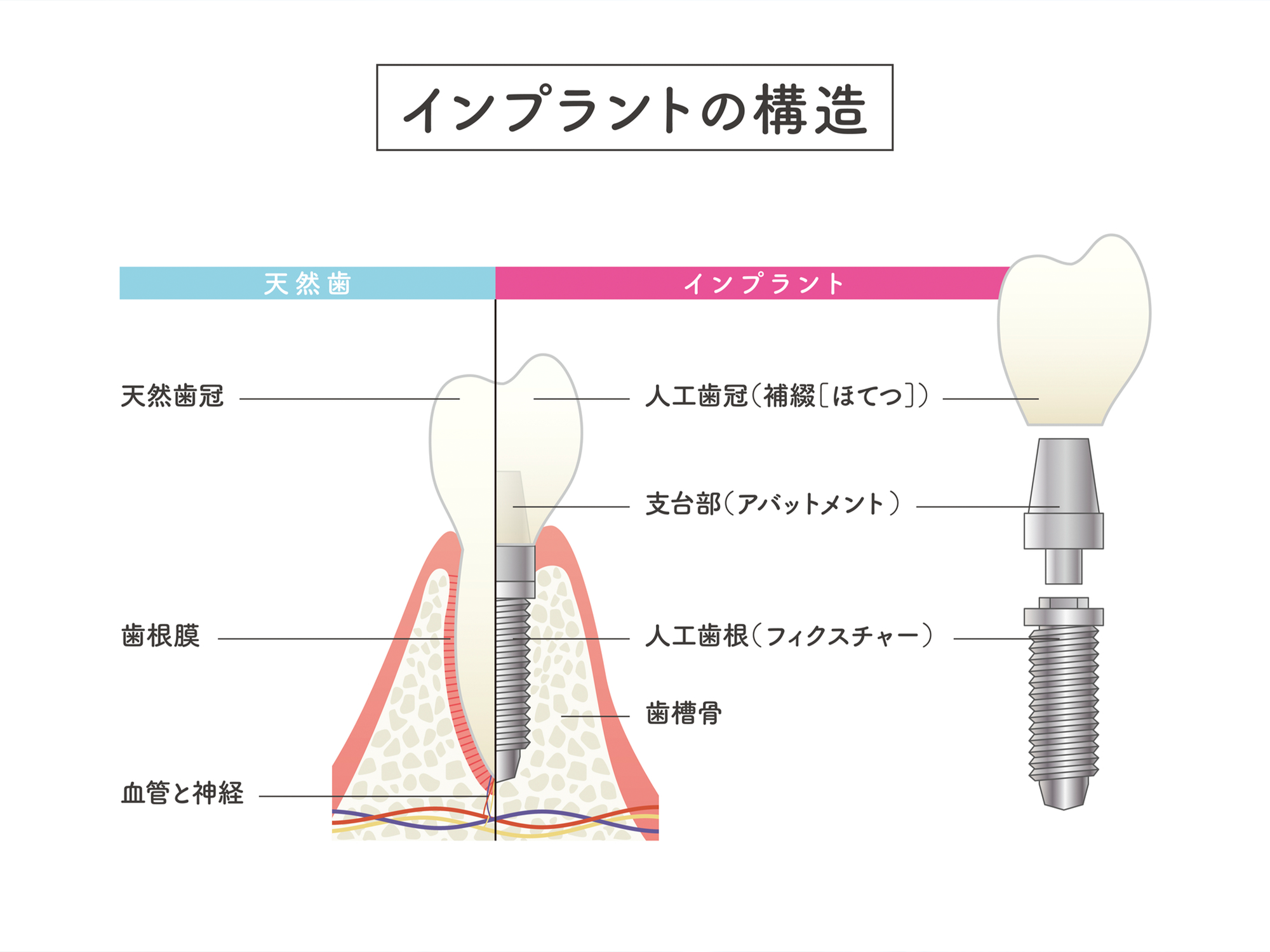 イラスト：インプラントのメリット